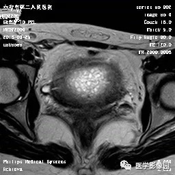 【病例】葡萄胎1例MR影像表现 【病例】葡萄胎1例MR影像表现