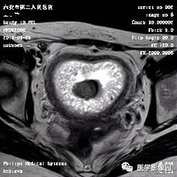 【病例】葡萄胎1例MR影像表现 【病例】葡萄胎1例MR影像表现