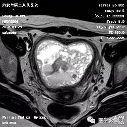 【病例】葡萄胎1例MR影像表现 【病例】葡萄胎1例MR影像表现