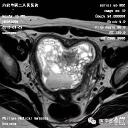 【病例】葡萄胎1例MR影像表现 【病例】葡萄胎1例MR影像表现
