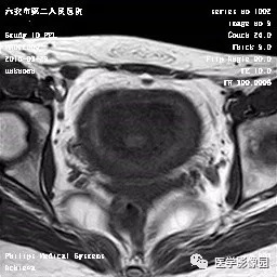 【病例】葡萄胎1例MR影像表现 【病例】葡萄胎1例MR影像表现