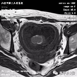 【病例】葡萄胎1例MR影像表现 【病例】葡萄胎1例MR影像表现