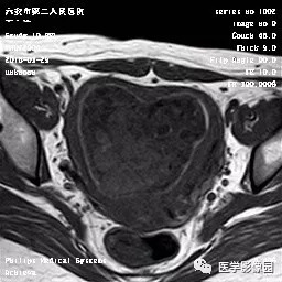 【病例】葡萄胎1例MR影像表现 【病例】葡萄胎1例MR影像表现
