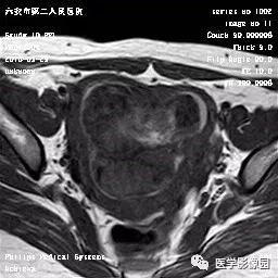 【病例】葡萄胎1例MR影像表现 【病例】葡萄胎1例MR影像表现