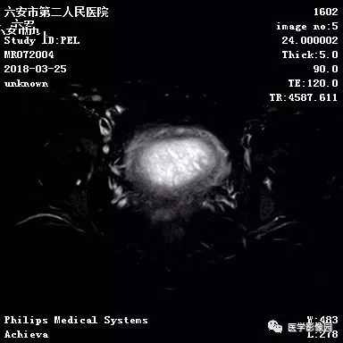 【病例】葡萄胎1例MR影像表现 【病例】葡萄胎1例MR影像表现