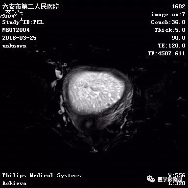 【病例】葡萄胎1例MR影像表现 【病例】葡萄胎1例MR影像表现