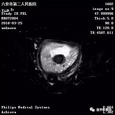 【病例】葡萄胎1例MR影像表现 【病例】葡萄胎1例MR影像表现
