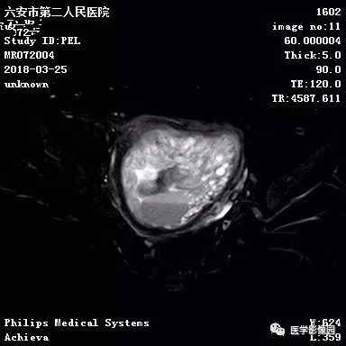 【病例】葡萄胎1例MR影像表现 【病例】葡萄胎1例MR影像表现