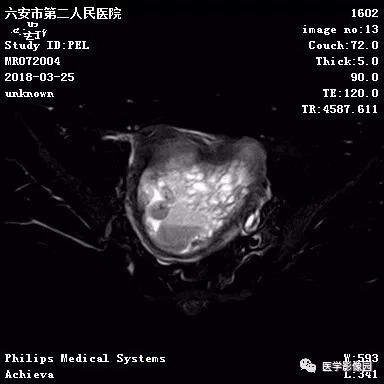 【病例】葡萄胎1例MR影像表现 【病例】葡萄胎1例MR影像表现