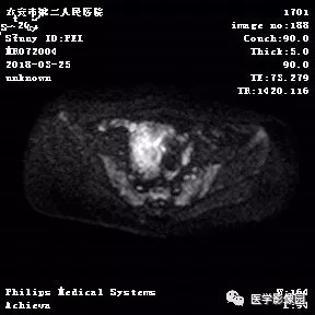 【病例】葡萄胎1例MR影像表现 【病例】葡萄胎1例MR影像表现