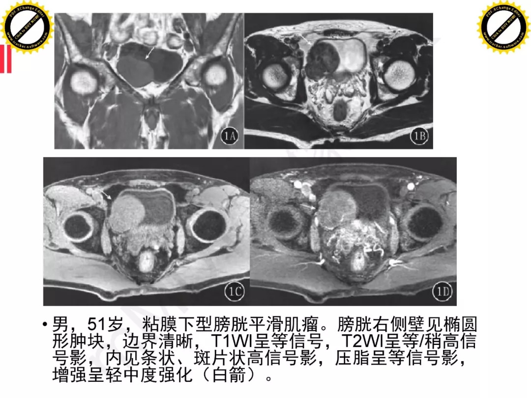 【PPT】膀胱非上皮良性肿瘤的影像诊断