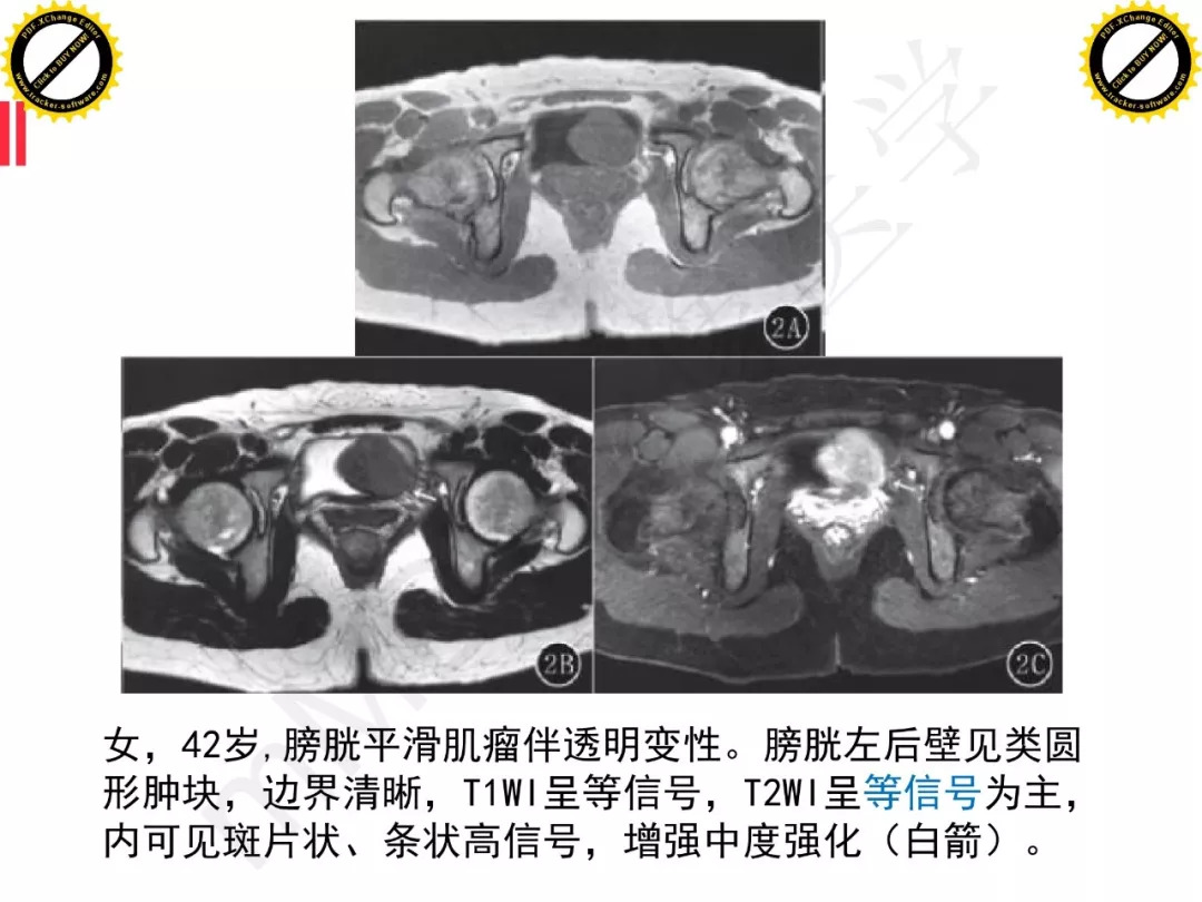 【PPT】膀胱非上皮良性肿瘤的影像诊断