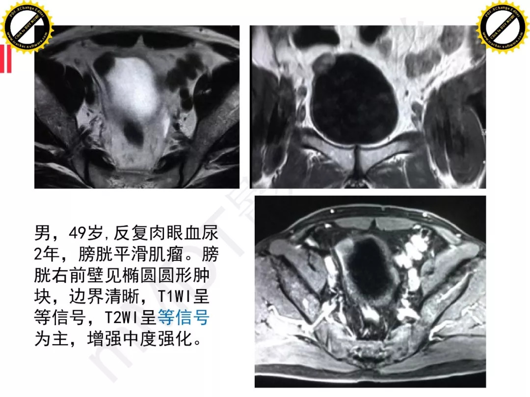 【PPT】膀胱非上皮良性肿瘤的影像诊断