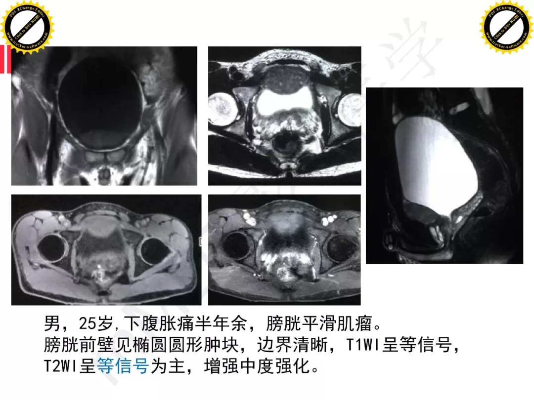 【PPT】膀胱非上皮良性肿瘤的影像诊断