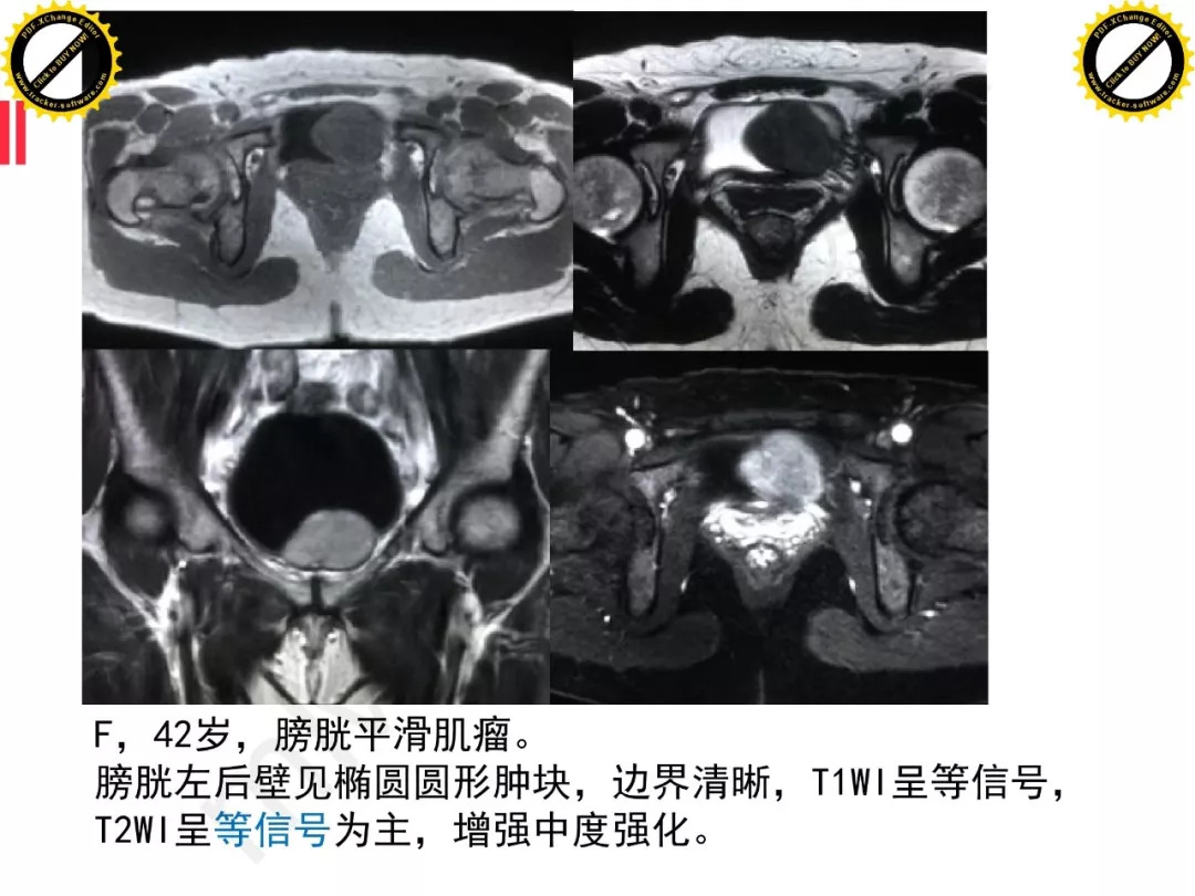 【PPT】膀胱非上皮良性肿瘤的影像诊断