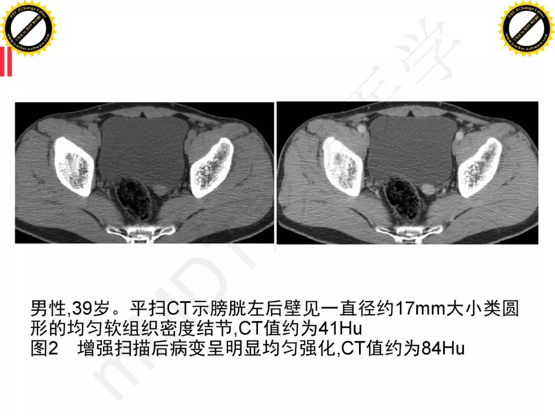 【PPT】膀胱非上皮良性肿瘤的影像诊断