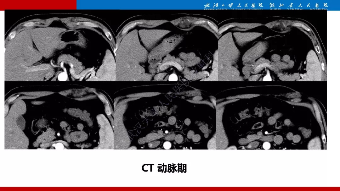 【PPT】木村病影像诊断