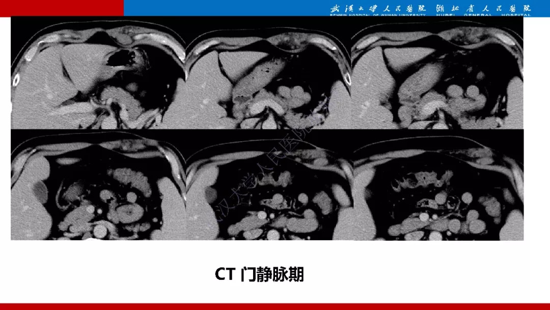 【PPT】木村病影像诊断