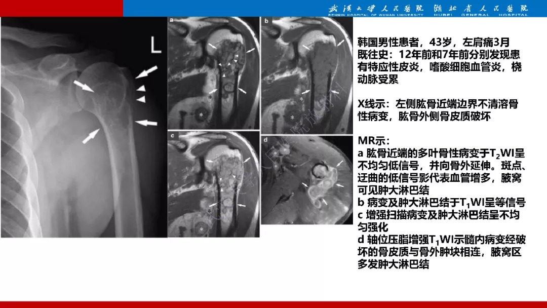 【PPT】木村病影像诊断