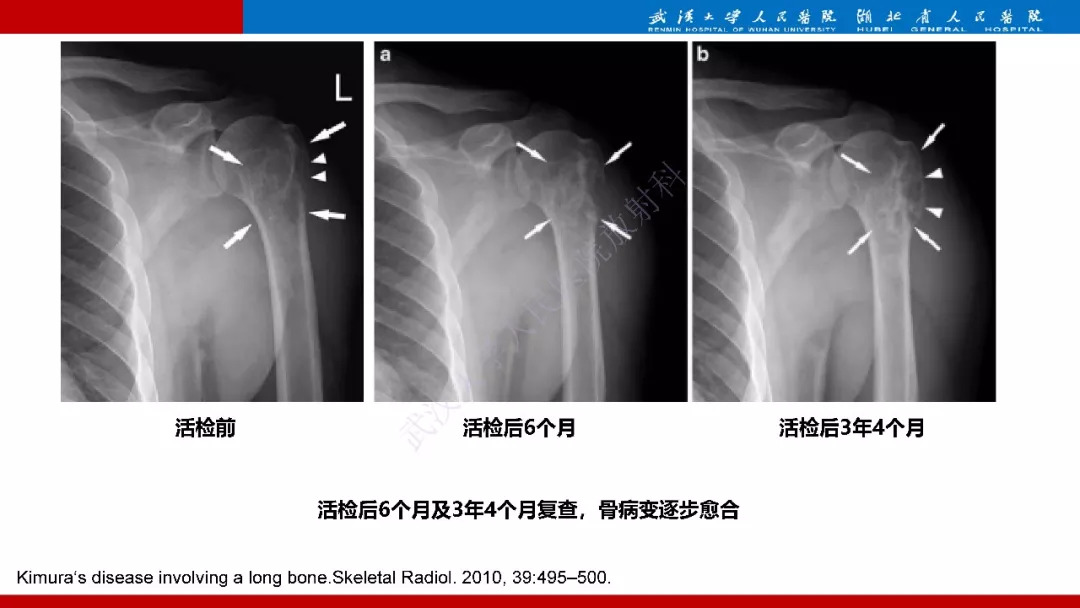 【PPT】木村病影像诊断