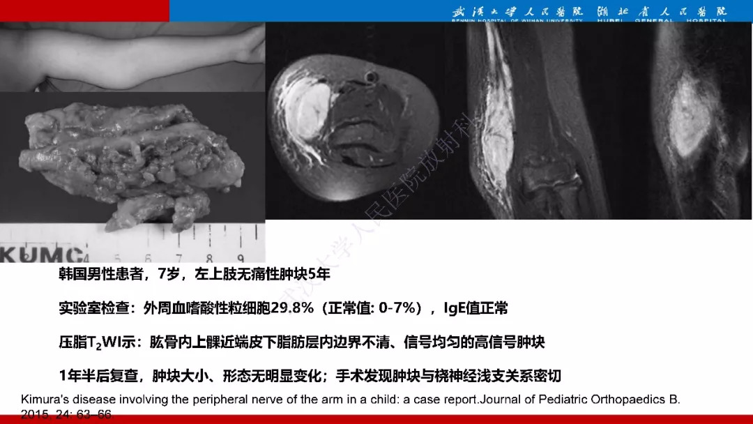 【PPT】木村病影像诊断
