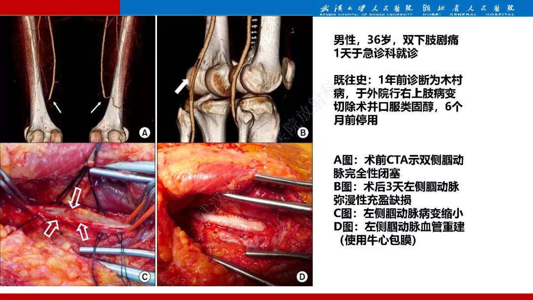 【PPT】木村病影像诊断