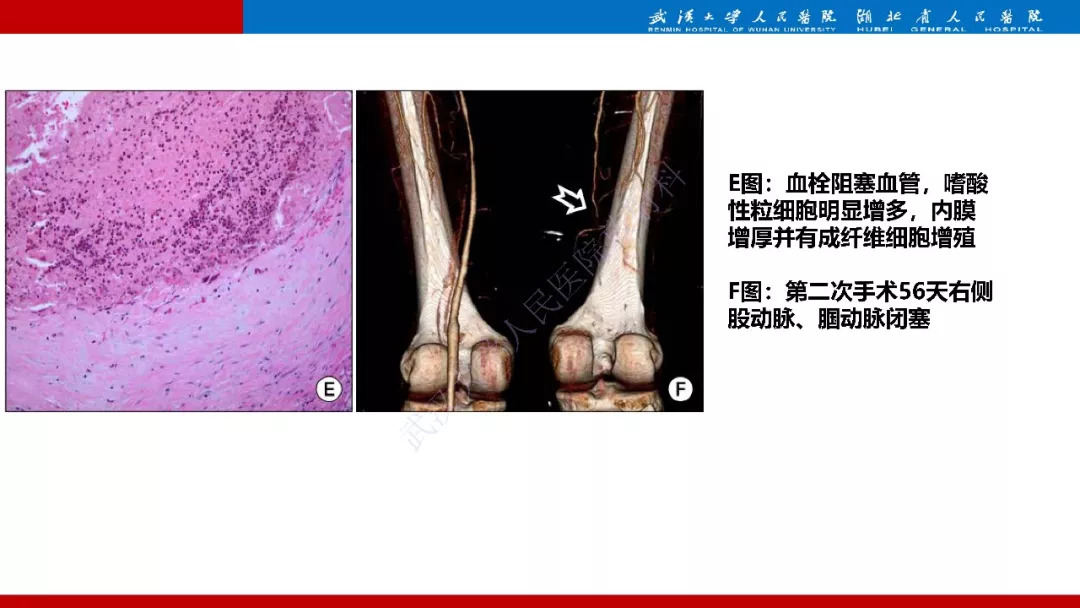 【PPT】木村病影像诊断