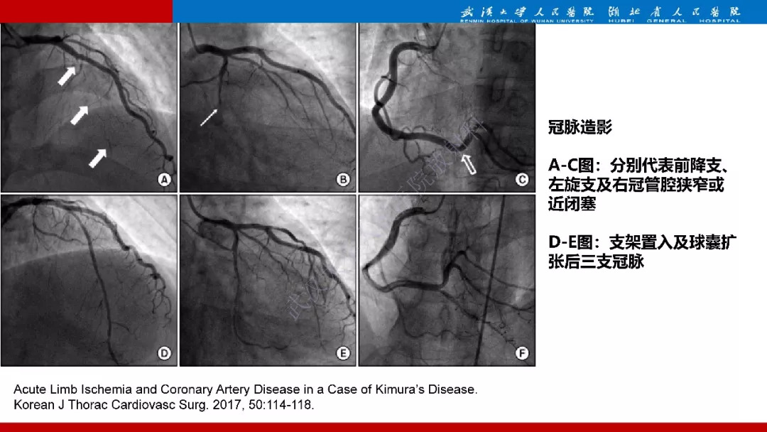 【PPT】木村病影像诊断