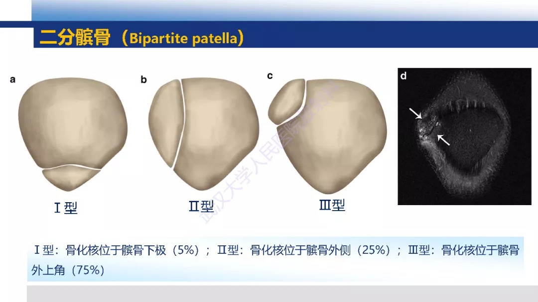 【PPT】膝关节解剖变异影像诊断