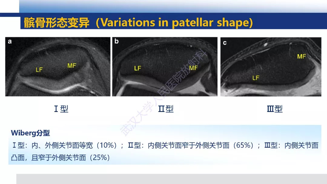 【PPT】膝关节解剖变异影像诊断