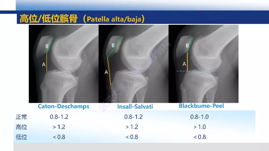 【PPT】膝关节解剖变异影像诊断
