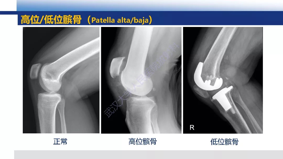 【PPT】膝关节解剖变异影像诊断