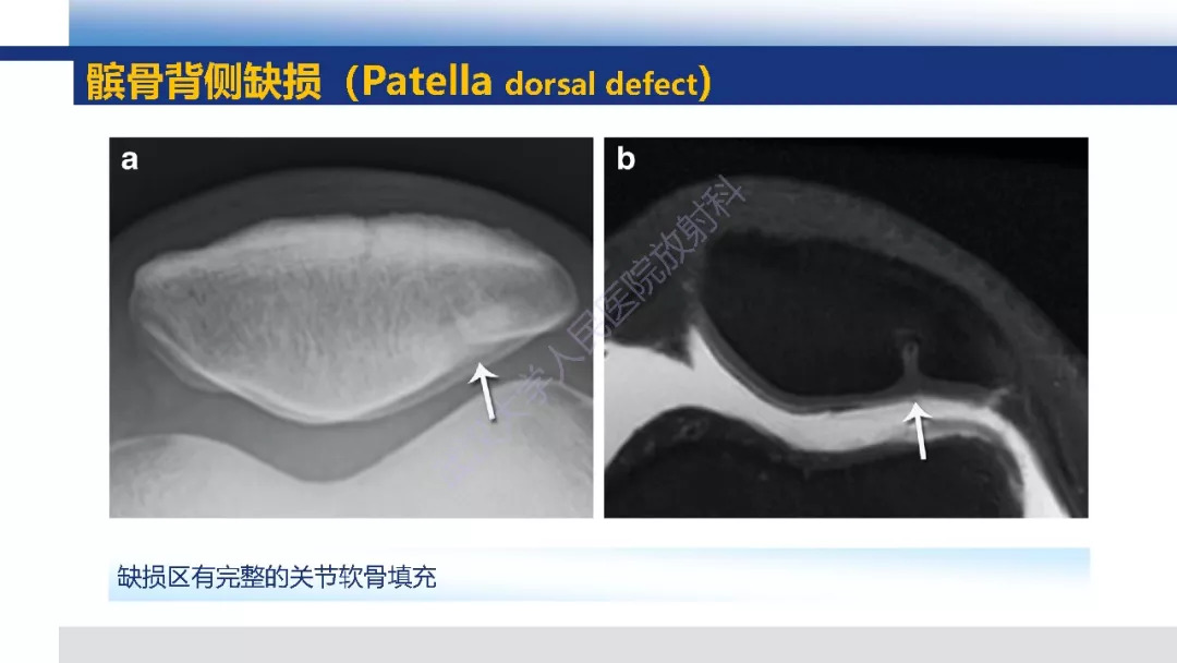 【PPT】膝关节解剖变异影像诊断