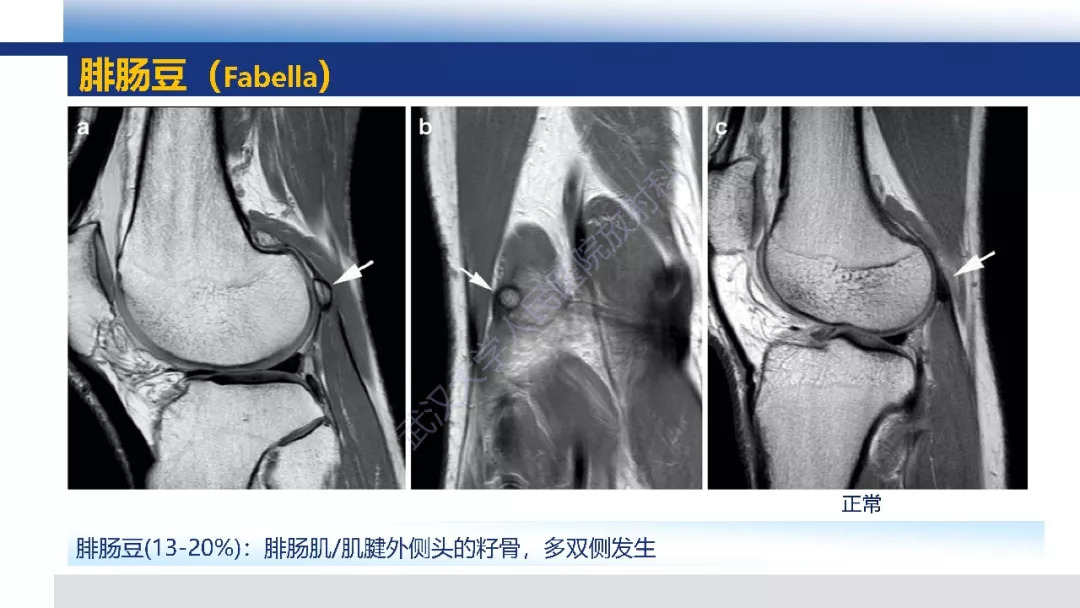 【PPT】膝关节解剖变异影像诊断