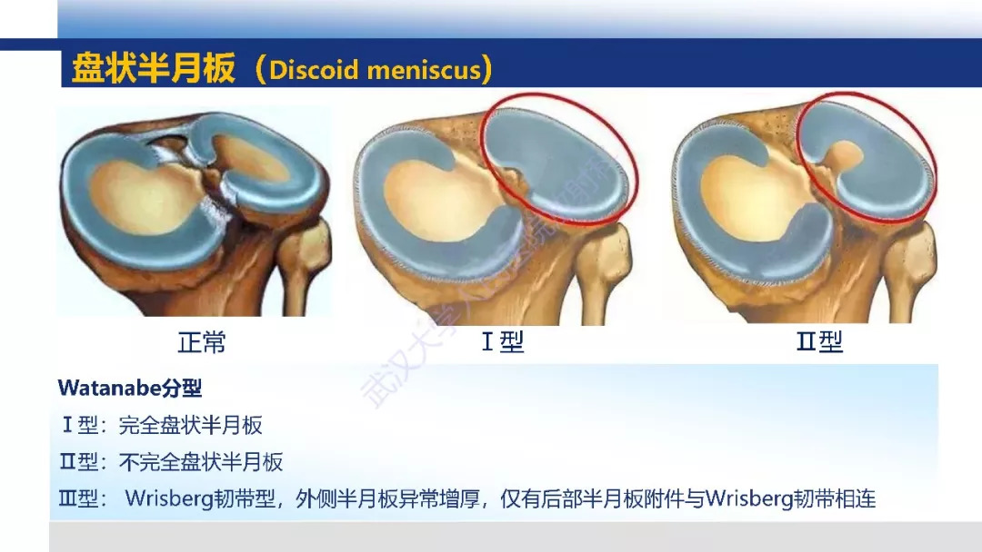 【PPT】膝关节解剖变异影像诊断