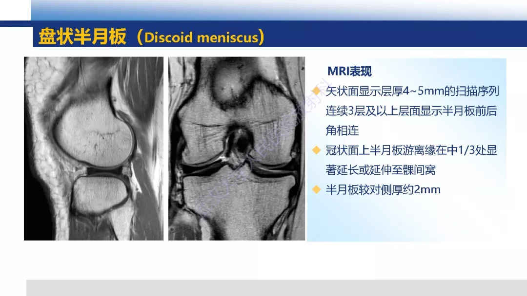 【PPT】膝关节解剖变异影像诊断