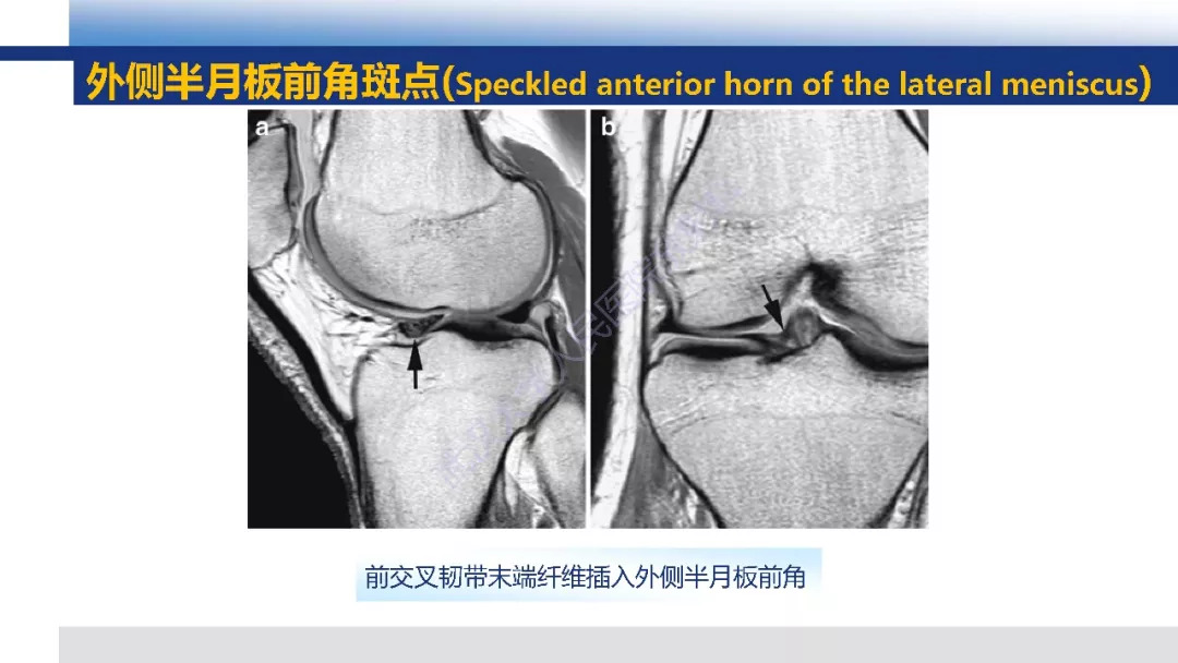 【PPT】膝关节解剖变异影像诊断