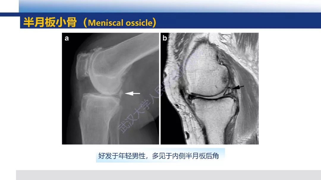 【PPT】膝关节解剖变异影像诊断