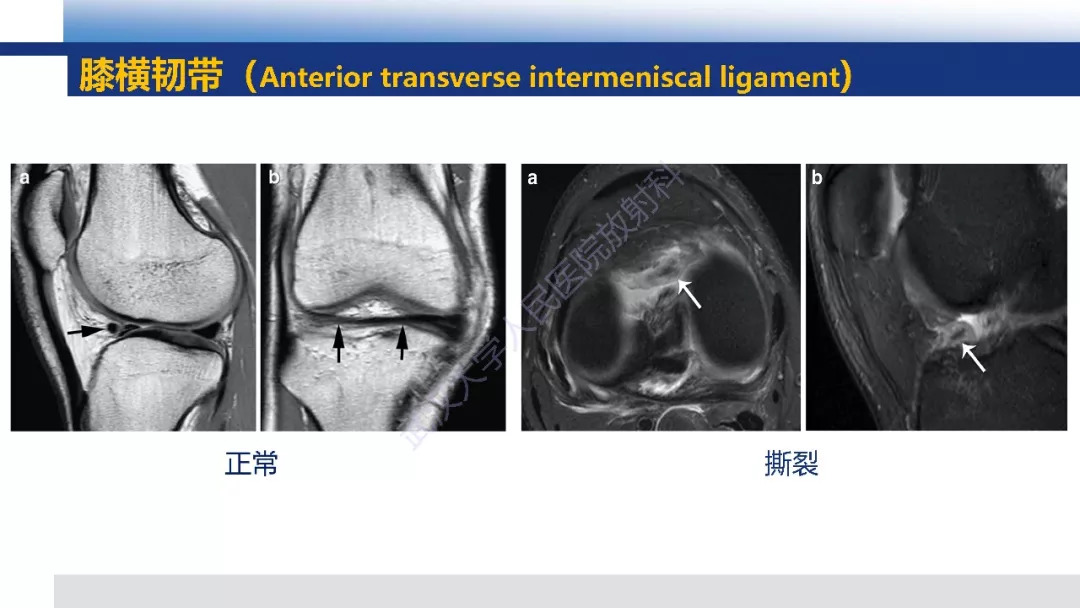 【PPT】膝关节解剖变异影像诊断