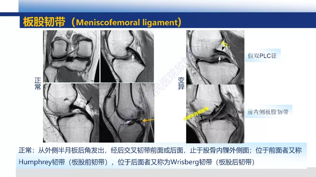 【PPT】膝关节解剖变异影像诊断