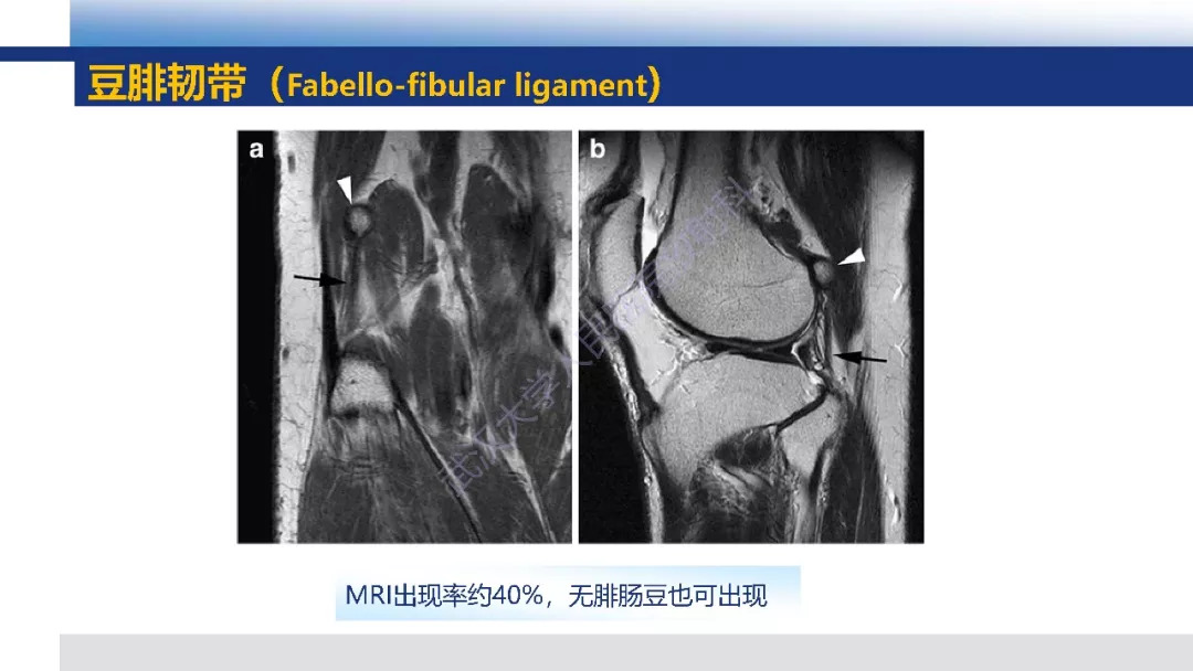 【PPT】膝关节解剖变异影像诊断