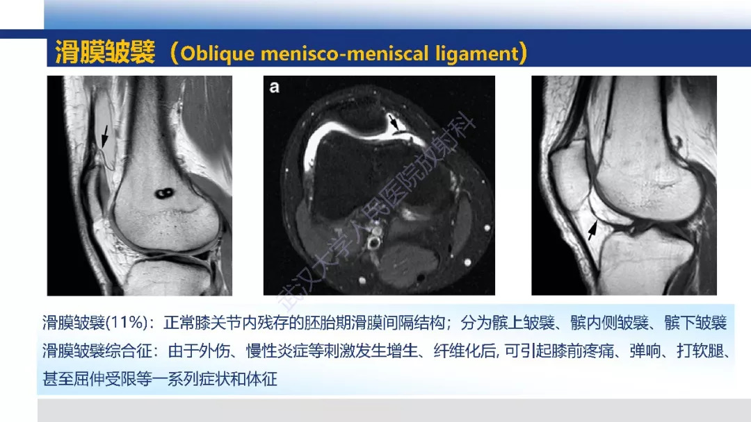 【PPT】膝关节解剖变异影像诊断