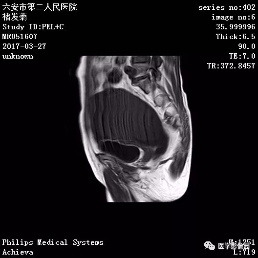 【病例】卵泡膜细胞瘤1例MR 【病例】卵泡膜细胞瘤1例MR