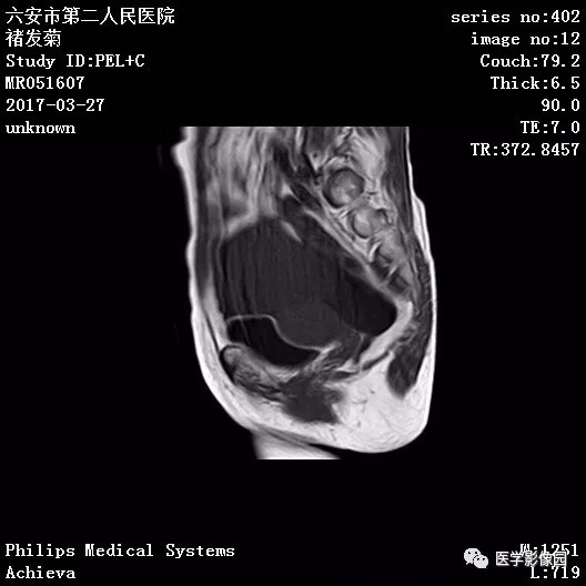 【病例】卵泡膜细胞瘤1例MR 【病例】卵泡膜细胞瘤1例MR