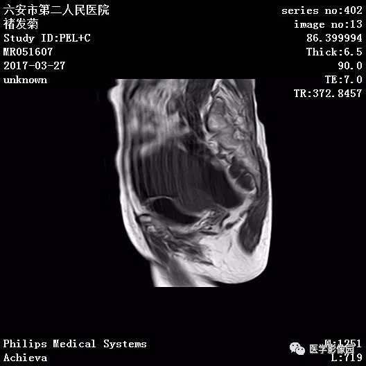 【病例】卵泡膜细胞瘤1例MR 【病例】卵泡膜细胞瘤1例MR