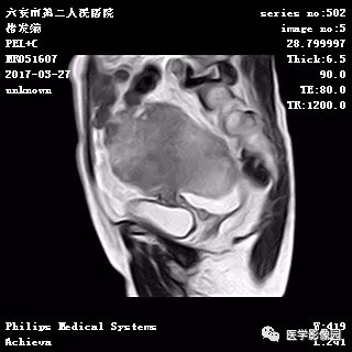 【病例】卵泡膜细胞瘤1例MR 【病例】卵泡膜细胞瘤1例MR