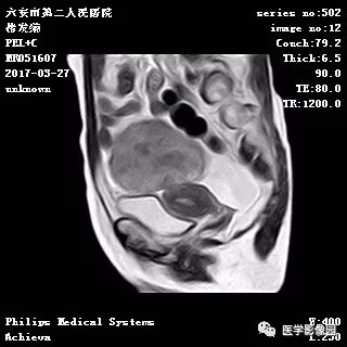 【病例】卵泡膜细胞瘤1例MR 【病例】卵泡膜细胞瘤1例MR