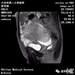 【病例】卵泡膜细胞瘤1例MR 【病例】卵泡膜细胞瘤1例MR