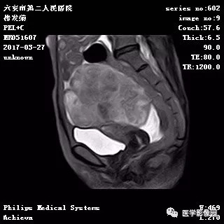 【病例】卵泡膜细胞瘤1例MR 【病例】卵泡膜细胞瘤1例MR