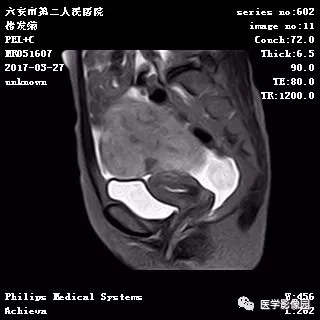 【病例】卵泡膜细胞瘤1例MR 【病例】卵泡膜细胞瘤1例MR